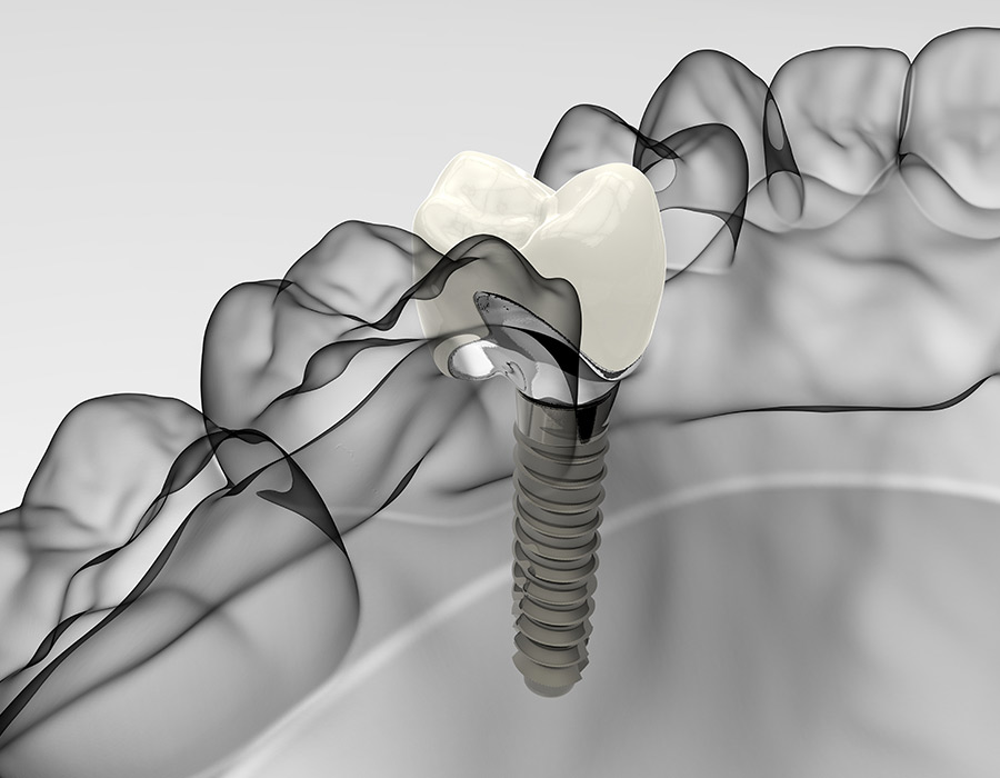 implants-dentals-lleida